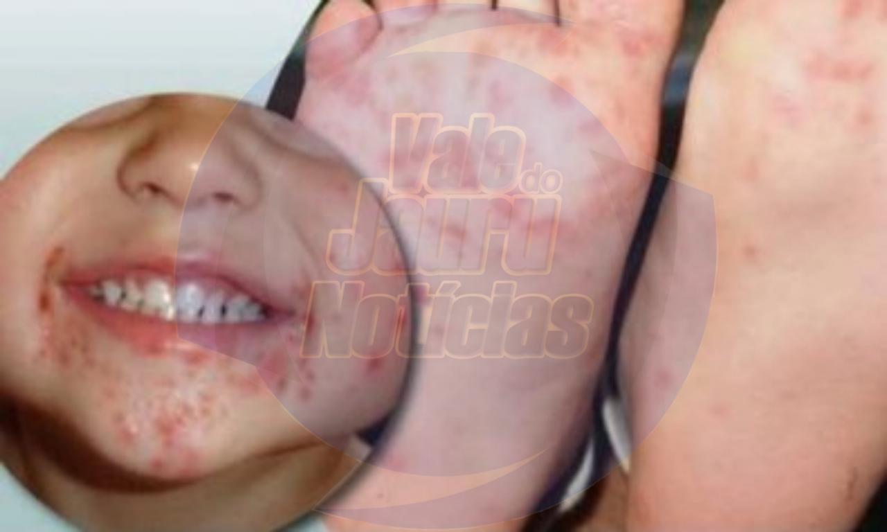 Criança de 2 anos contrai doença 