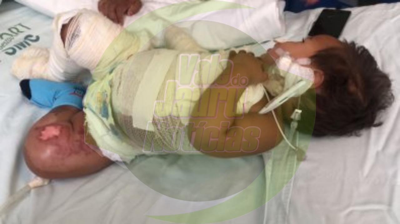 Bebê morre em hospital após ter 80% do corpo queimado