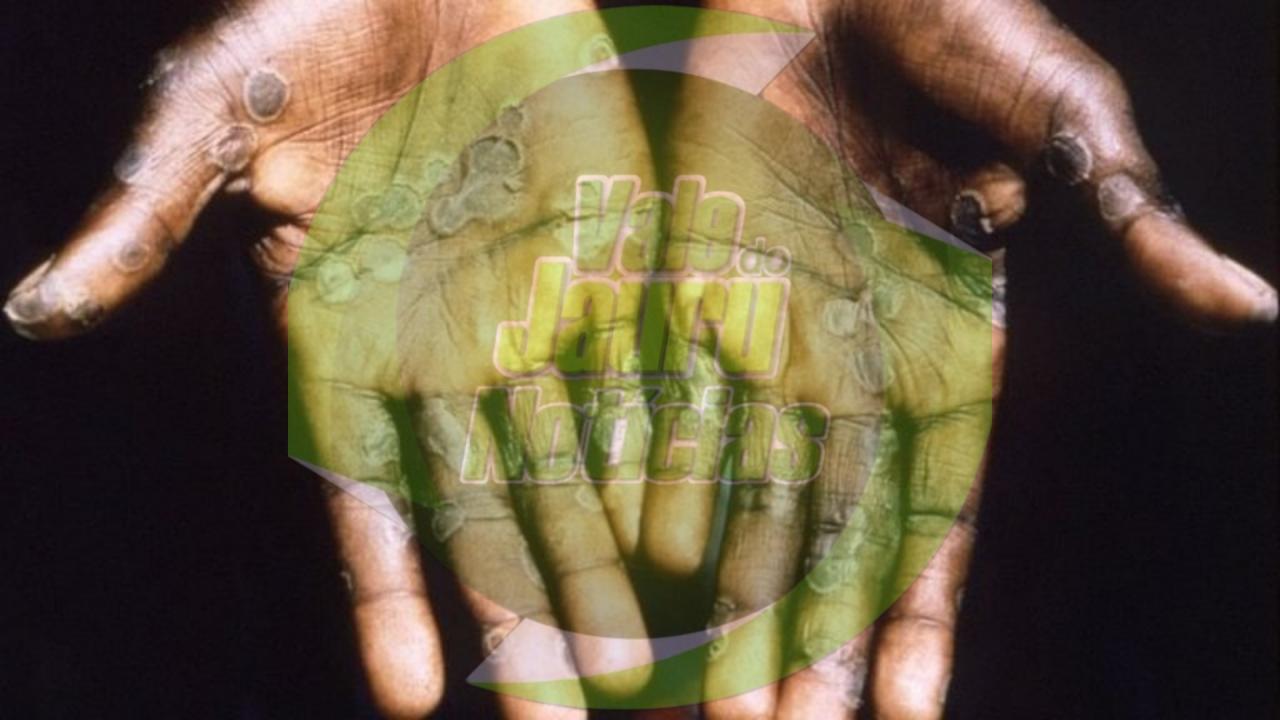 Município em MT registra denúncia de caso suspeito de varíola de macacos e entra em estado de alerta Mato Grosso