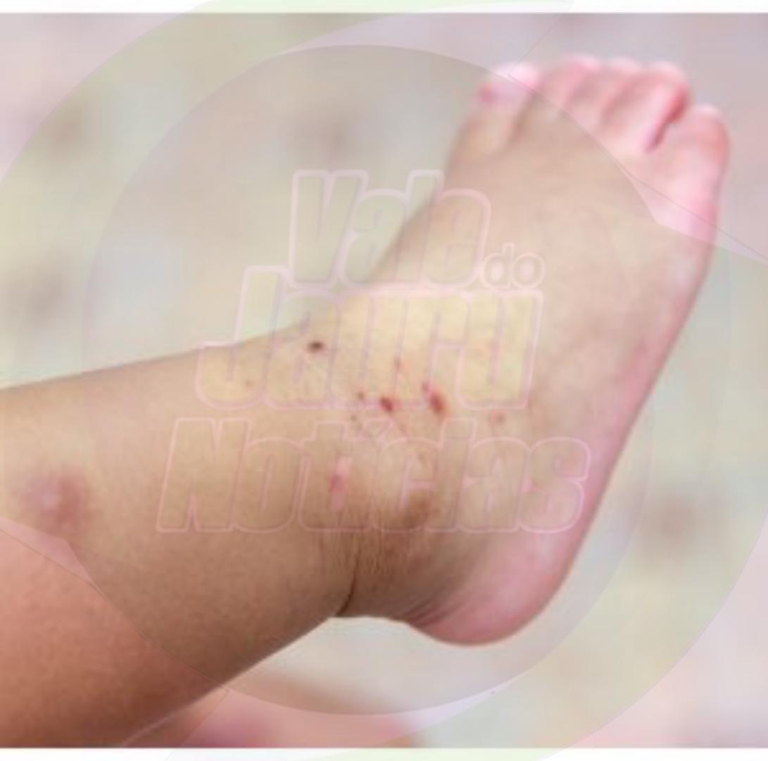 Febre alta e dor no corpo; virose ataca crianças e adultos em Cuiabá