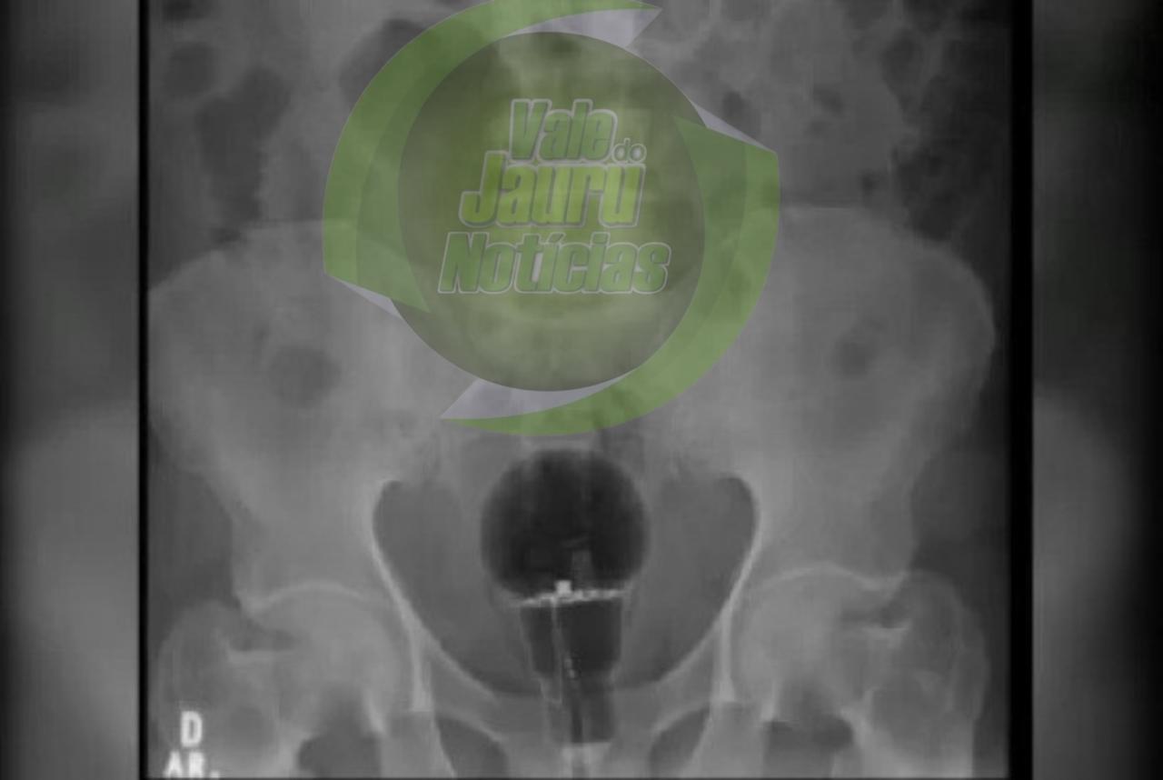 Paciente colombiano passa por procedimento para retirar lâmpada do ânus